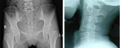 隔代遗传 让他患上强直性脊柱炎 隔代遗传 让他患上强直性脊柱炎