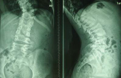 强直险让大巴司机失业 来我院治疗后让他重掌方向盘 强直险让大巴司机失业 来我院治疗后让他重掌方向盘
